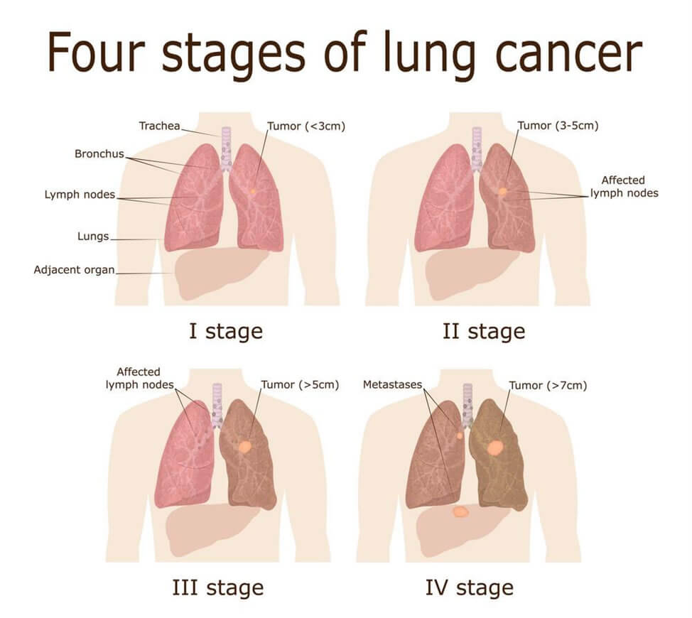 Lungs Cancer Treatment in Vienna, VA